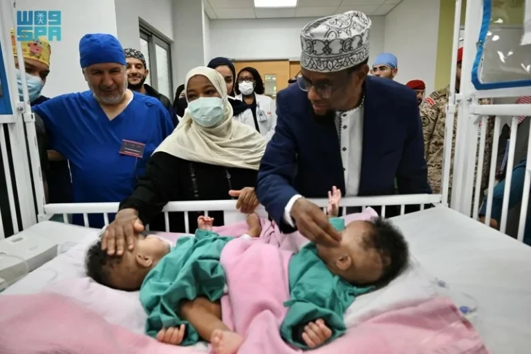 تفاصيل عملية فصل التوأم الصومالي رحمة ورملا في الرياض