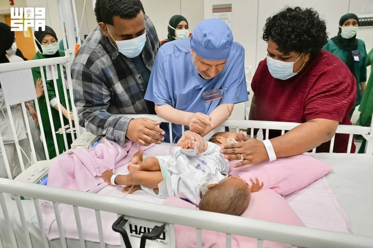 بدء عملية فصل التوأم الفيجي بنسبة نجاح 70% في الرياض